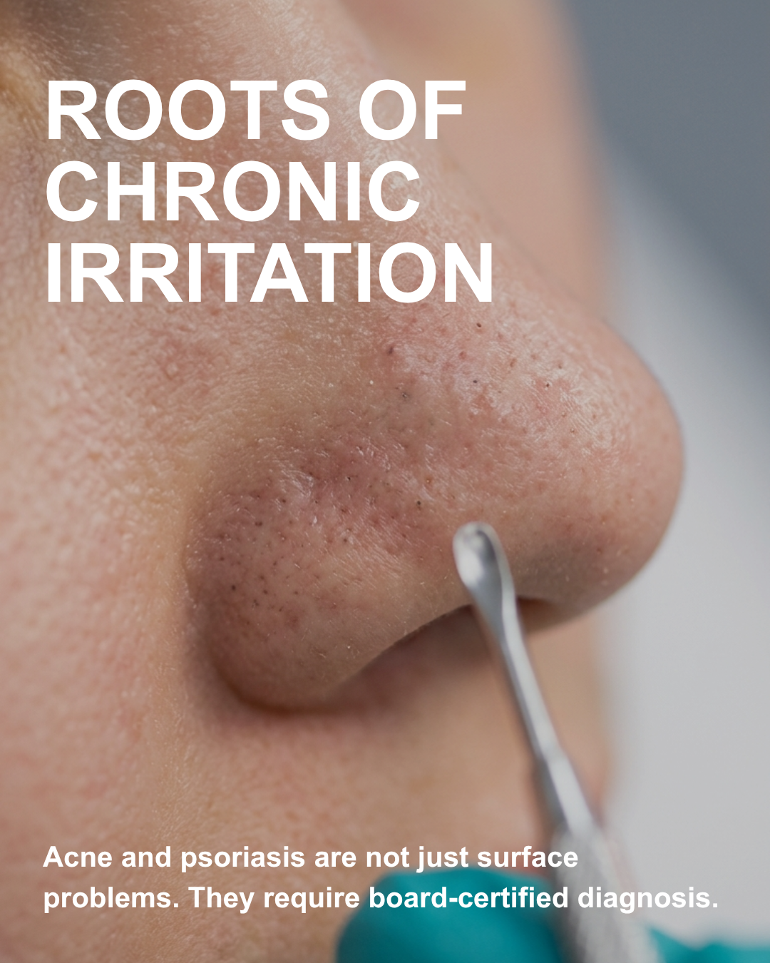 Trusted dermatologist in Astoria post covering acne eczema and rashes